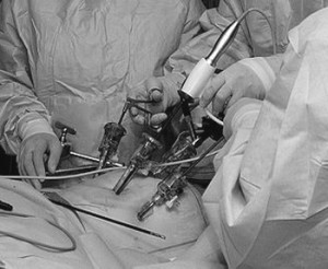 Fertility Enhancing Laparoscopic Surgery