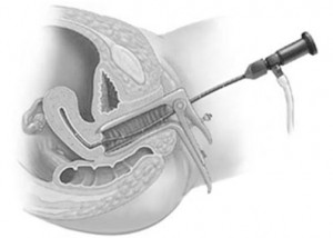 Fertility Enhancing Hysteroscopic Surgery