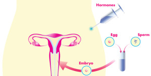 in vitro fertilization